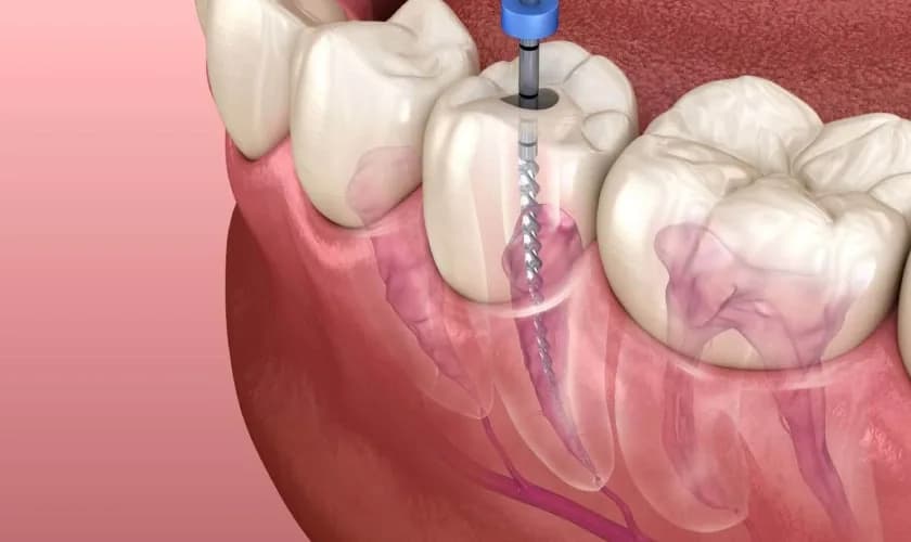 Endodontische Behandlung unter dem Mikroskop